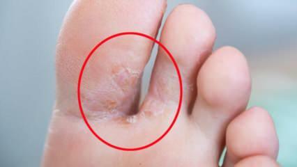 Kas ir pēdu sēnīte? Kādi ir pēdu sēnītes simptomi? Vai ir ārstējama sportista pēda?