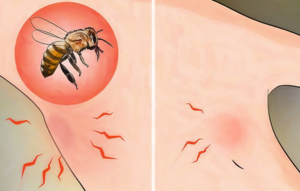 Kas ir bišu alerģija un kādi ir simptomi? Dabiskas metodes, kas ir piemērotas bišu dzēlieniem