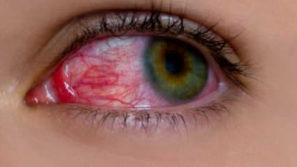 Kas izraisa acu alerģiju? Kādi ir acu alerģijas simptomi? Kas ir labs acu alerģijām? 