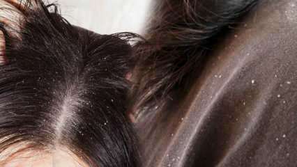 Kā blaugznas iziet un kas ir labs blaugznas matiem? 5 ātrākās un efektīvākās blaugznu noņemšanas metodes