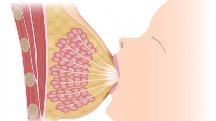 Kas ir mastīts (krūts iekaisums)? Mastīta simptomi un ārstēšana zīdīšanas laikā