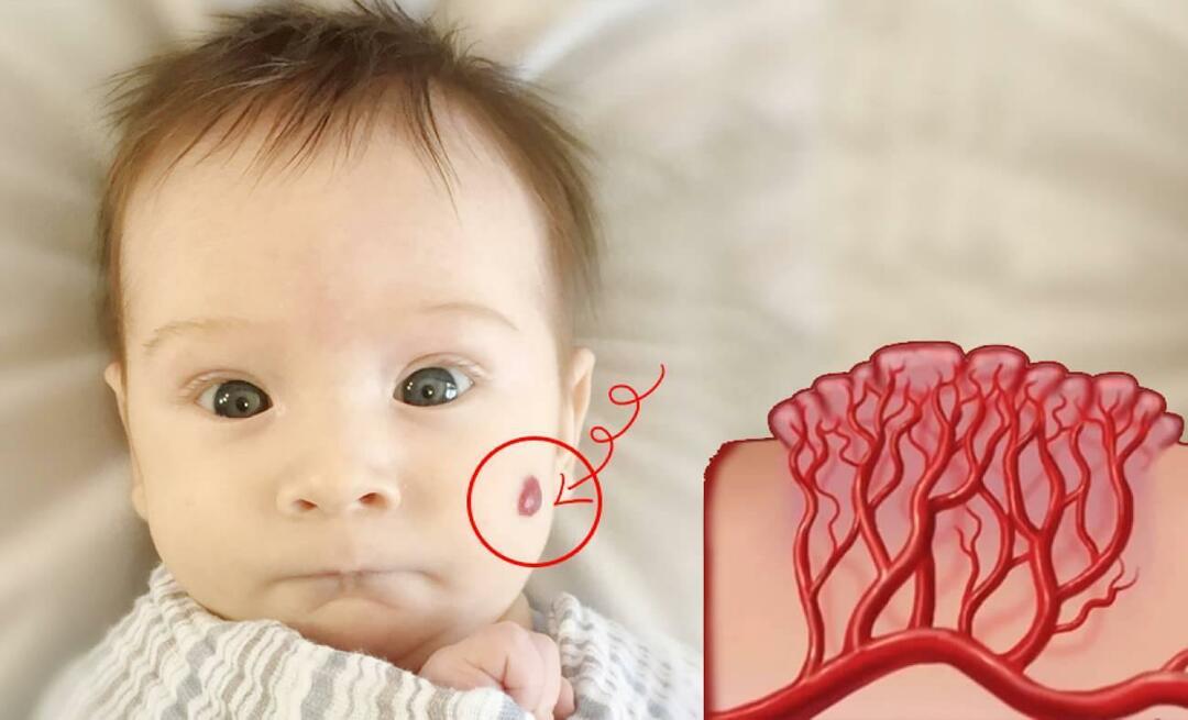 Kas ir hemangiomas vēnu nevi? Kas izraisa hemangiomu, kāda ir tās ārstēšana?