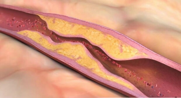 Kas izraisa aterosklerozi? Cik ir asinsvadu oklūzijas veidu?