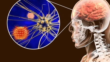 Kas ir meningīts un kādi ir tā simptomi? Vai ir meningīta ārstēšana?