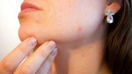 Kas ir ādas vēzis (melanoma)? Kādi ir melanomas simptomi un vai ir iespējams izārstēt?