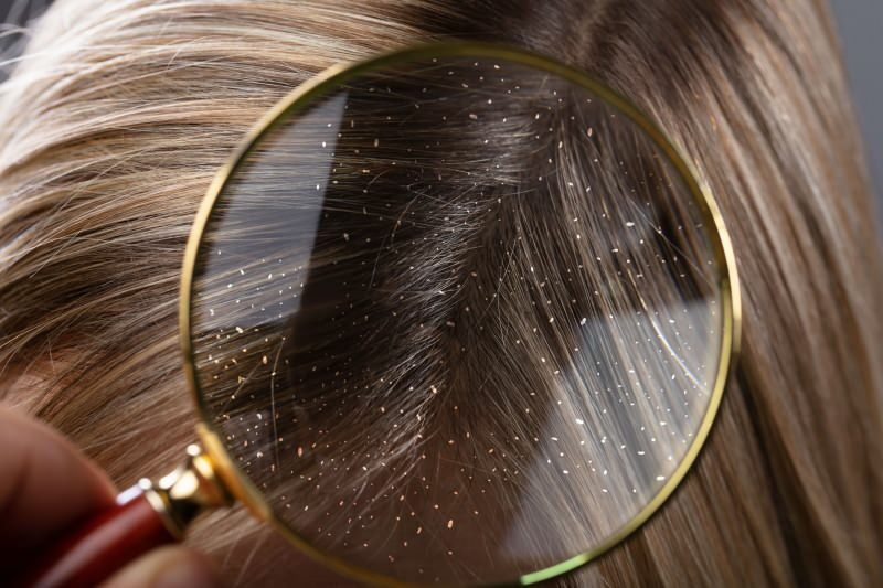 Kā blaugznas iziet un kas ir labs blaugznas matiem? 5 ātrākais un efektīvākais līdzeklis pret blaugznām