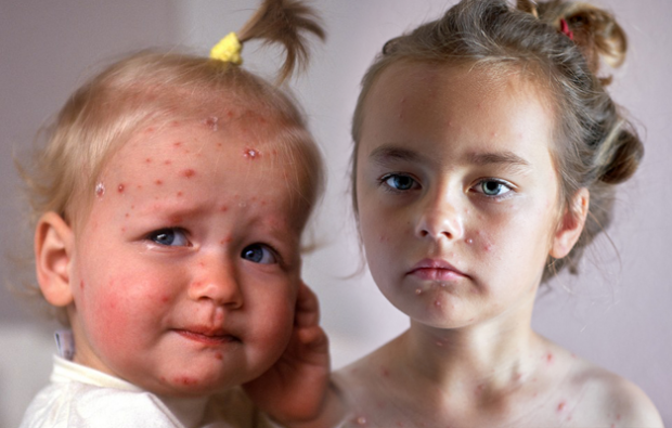 Kā saprast vējbakas zīdaiņa vecumā un bērnībā? Vējbakas simptomi un ārstēšana