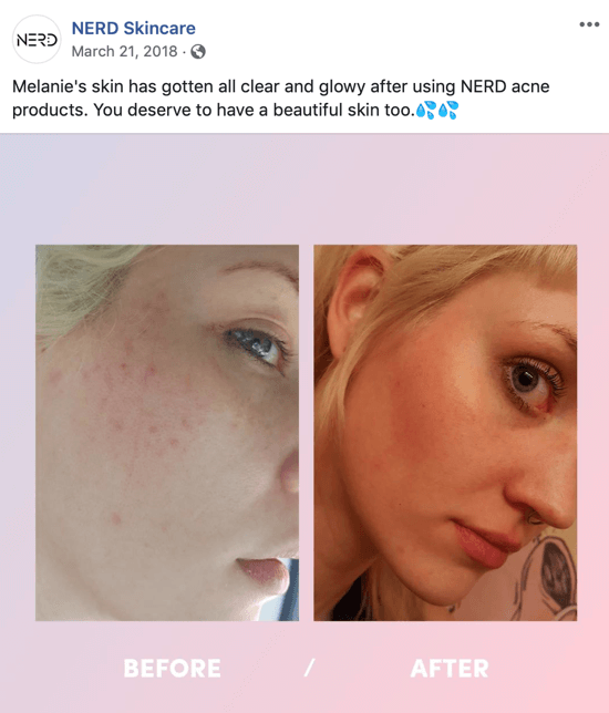 Piemērs tam, kā Nerd Skincare izmantoja attēlu pirms un pēc, lai izveidotu attēla ierakstu sociālajiem medijiem, kas veicina viņu produktu pirkšanu.