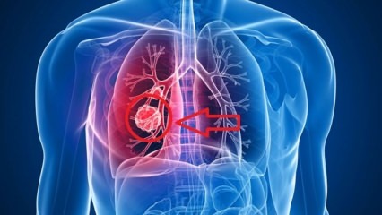 Plaušu vēža simptomi: plaušu vēža stadijas!