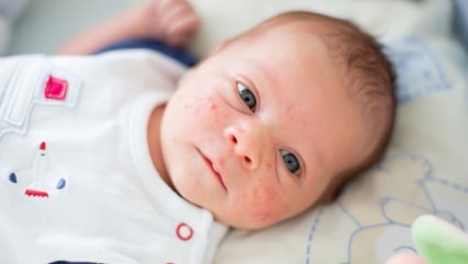 Kā notiek pūtītes uz mazuļa sejas? Pūtītes (Milia) žāvēšanas metodes
