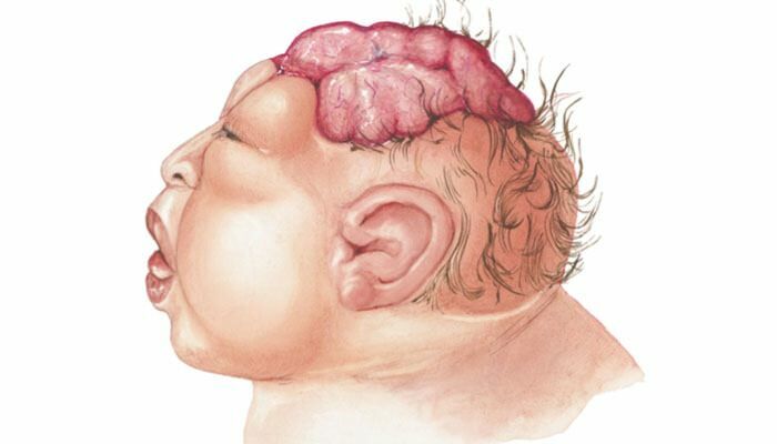 Kas ir anencefalija? Kādi ir anecefālijas simptomi zīdaiņiem un bērniem? Anencefālija izraisa ...