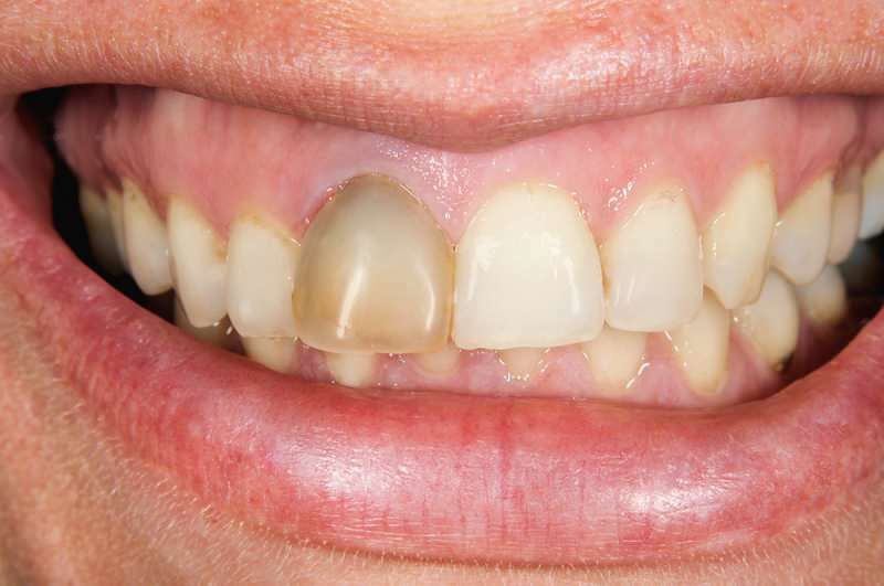 zobu satumšana dažreiz var koncentrēties uz vienu zobu