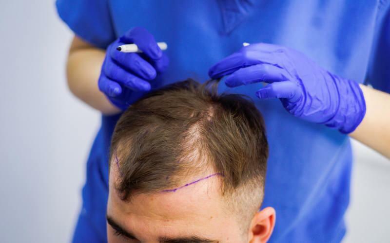 Vai matu izkrišanas ārstēšanā ir atļauts pārstādīt matus? Kas ir matu protezēšana? Vai matu protezēšana traucē ghuslam?