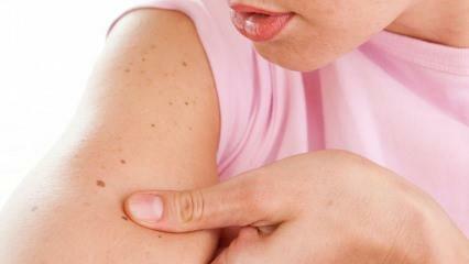 Kas ir ādas (ādas) vēzis un kādi ir tā simptomi? Veidi, kā izprast ādas vēzi