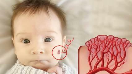 Kas ir hemangiomas vēnu nevi? Kas izraisa hemangiomu, kāda ir tās ārstēšana?