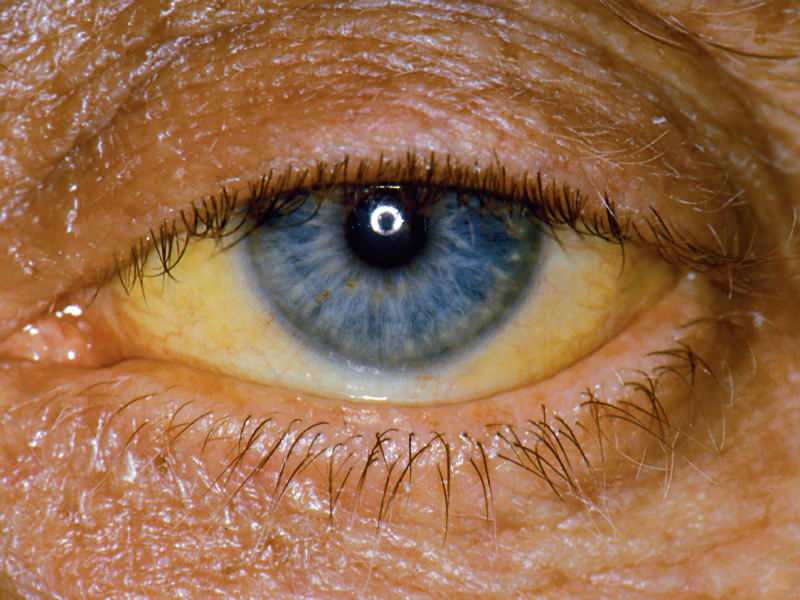 augstums bilirubīna līmenī izraisa dzeltenu krāsu acīm un ādai