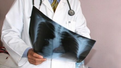 Eksperti paziņoja! Palielināts plaušu vēža izraisīto nāves gadījumu skaits