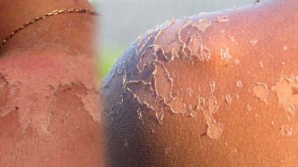 Kas ir labs ādas lobīšanai un kā notiek ādas pīlings? Mājas līdzeklis pret ādas pīlingu
