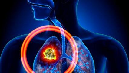Kādi ir plaušu vēža simptomi? Vai ir plaušu vēža ārstēšana?