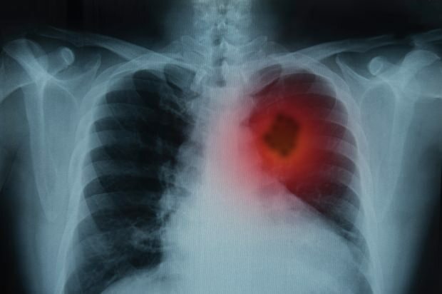 Vai tiek ārstēta plaušu vēzis?