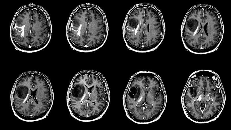 Kas izraisa smadzeņu audzēju? Kādi ir smadzeņu audzēja simptomi? Vai smadzeņu audzēja ārstēšana ir sarežģīta?