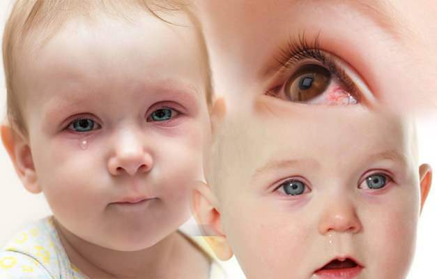 izraisa acu asiņošanu zīdaiņiem