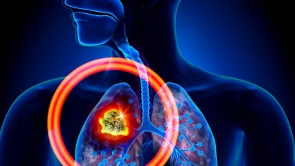 Kādi ir plaušu vēža simptomi? Vai tiek veikta plaušu vēža ārstēšana? Lai novērstu plaušu vēzi ...