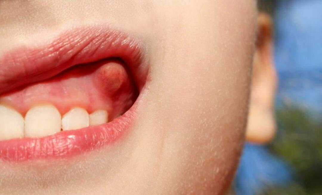Kāpēc veidojas zoba abscess un kādi ir simptomi? Zobu abscess, kā tas tiek ārstēts?