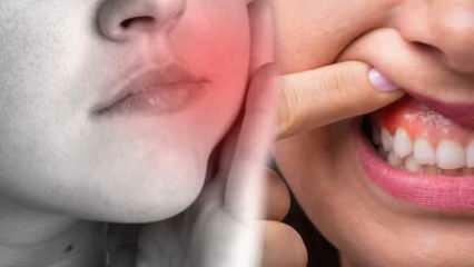 Kas izraisa zobu abscesu? Kādi ir simptomi un cik dienu laikā? Dabiski risinājumi zobu abscesam...