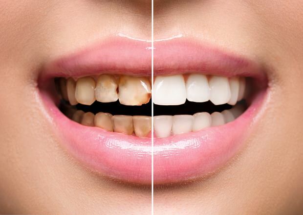 Neveselīga uztura rezultātā notiek gan zobu krāsas maiņa, gan zobu zaudēšana
