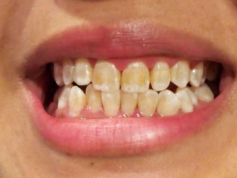 tāda cilvēka zoba attēls, kura zobi sāk satumst