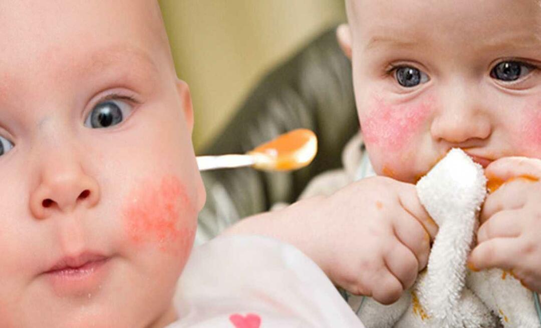 Ko vajadzētu ēst bērnam ar alerģiju? Kādi ir alternatīvi ēdieni alerģiskiem zīdaiņiem?