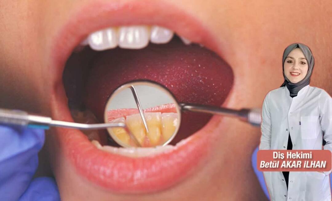Kas jādara, lai izvairītos no zobakmens? Kādas ir zobu mērogošanas priekšrocības?