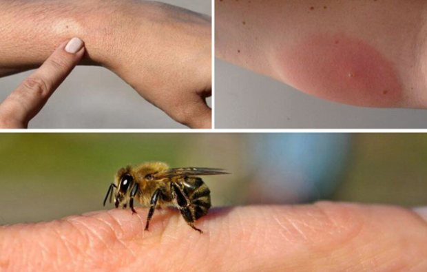 bišu alerģijas simptomi