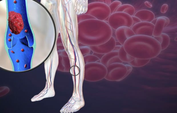 samazināta asinsrite kāju vēnās izraisa sāpes